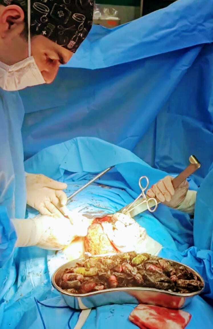 خروج ۹۰ بسته مواد مخدر از معده و روده بیماری در کرج&nbsp;